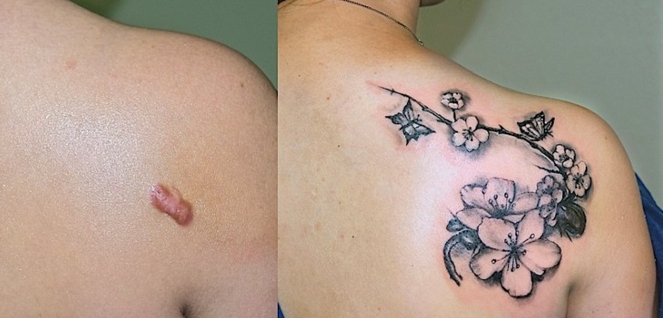 tatuagens-para-cobrir-cicatrizes8